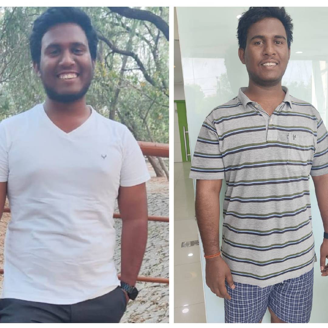 Body contouring transformation with non-surgical liposuction in 6 weeks